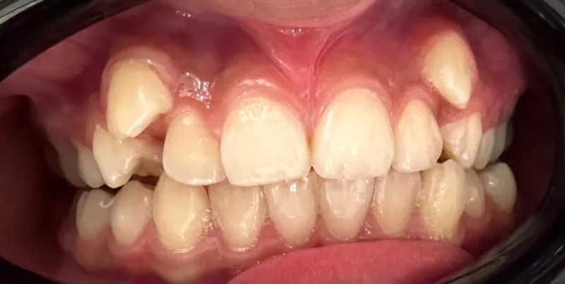 Brackets metalicos